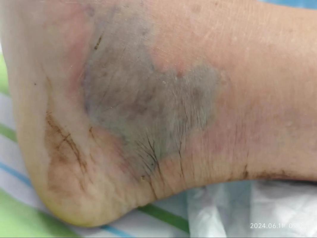 香港今晚开奖结果开奖记录和被蛇咬两年仍后遗症与被蛇咬了几年后身体有毒素吗
